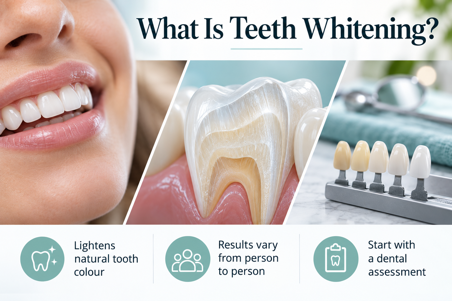 What Is Teeth Whitening?. Lightens natural tooth colour. Results vary from person to person. Start with a dental assessment